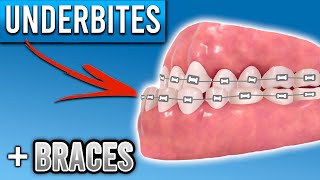 How Do Braces Fix Underbites  Premier Orthodontics [upl. by Vance]