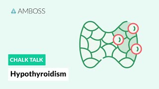 Hypothyroidism A Diagnostic Approach [upl. by Leede]