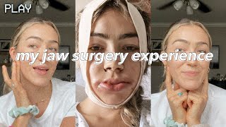 UNDERBITE JAW SURGERY  vlog  recovery days 114  before amp after [upl. by Adlare]