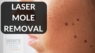 LASER MOLE REMOVAL [upl. by Sherfield]