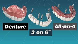 Alternative to Dentures Comparing Dentures Overdentures Allon4 and 3 on 6™ [upl. by Ecilef]