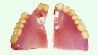 How to Repair a Broken Denture in 25 Minutes [upl. by Unders23]