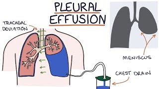 Understanding Pleural Effusions [upl. by Luhey752]