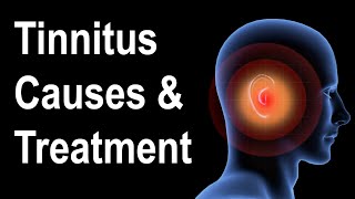 What is Tinnitus Causes amp Treatment Strategies [upl. by Yenroc519]