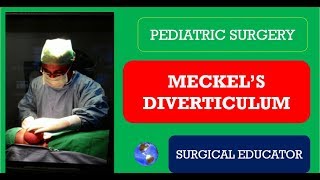 MECKELS DIVERTICULUM How To DIAGNOSE amp TREAT Pediatric Surgery [upl. by Alaik]